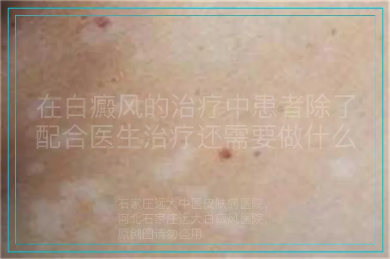 在白癜风的治疗中患者除了配合医生治疗还需要做什么呢