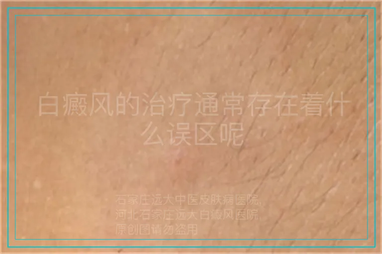 白癜风的治疗通常存在着什么误区呢