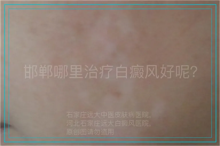邯郸哪里治疗白癜风好呢？