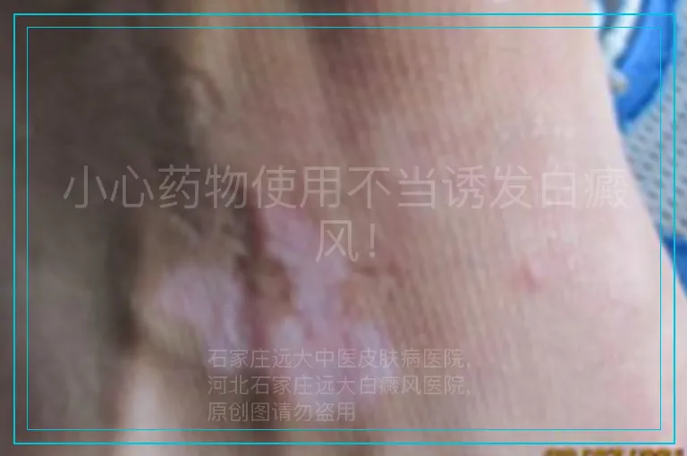 小心药物使用不当诱发白癜风!