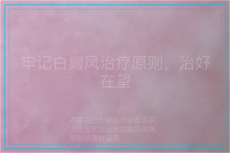 牢记白癜风治疗原则，治好在望