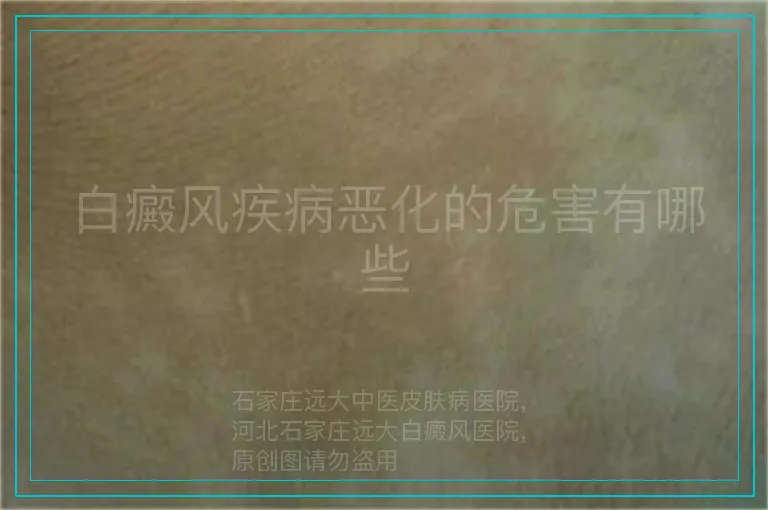白癜风疾病恶化的危害有哪些