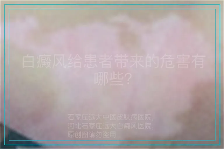 白癜风给患者带来的危害有哪些？