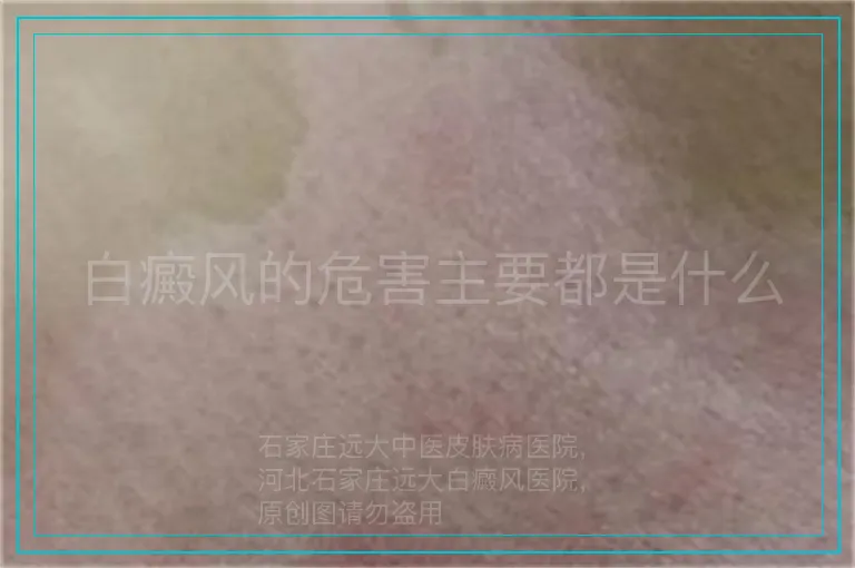 白癜风的危害主要都是什么