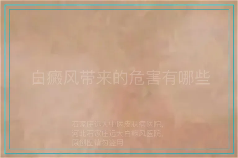 白癜风带来的危害有哪些