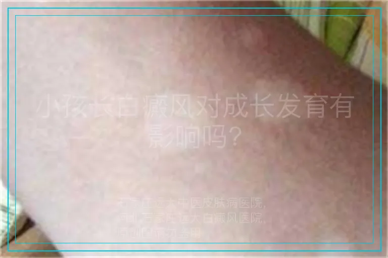 小孩长白癜风对成长发育有影响吗?
