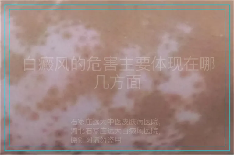 白癜风的危害主要体现在哪几方面