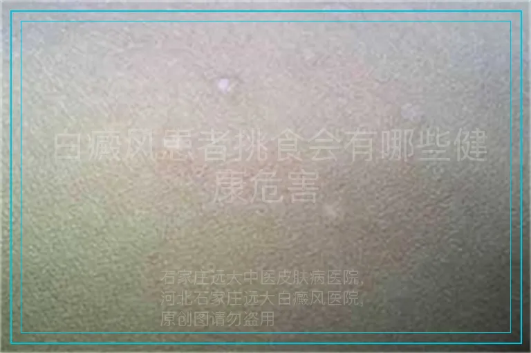 白癜风患者挑食会有哪些健康危害