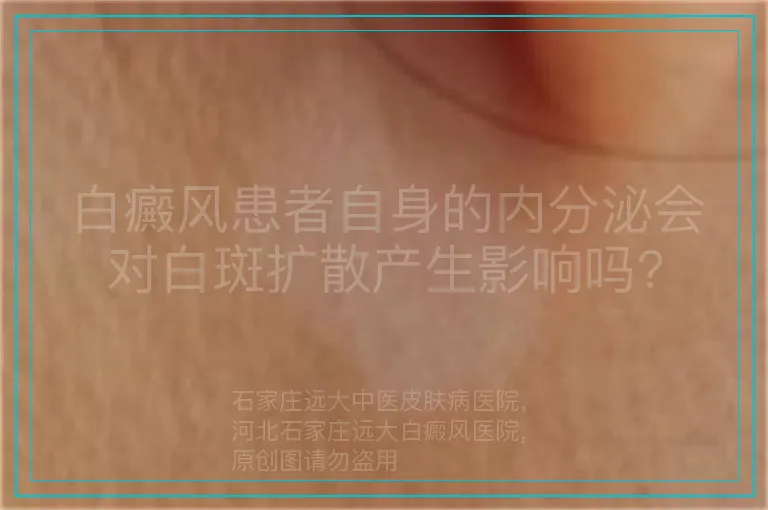 白癜风患者自身的内分泌会对白斑扩散产生影响吗?