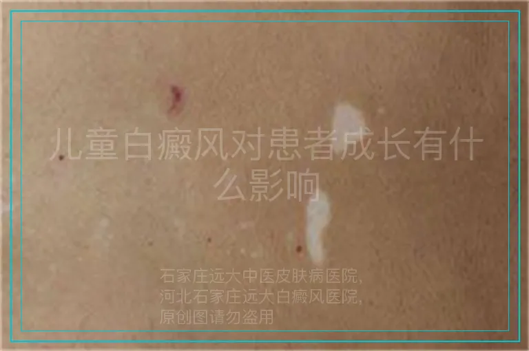 儿童白癜风对患者成长有什么影响