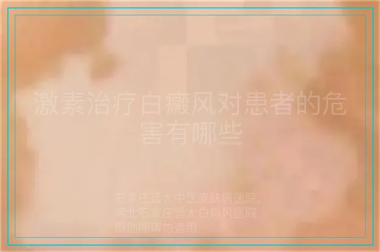 激素治疗白癜风对患者的危害有哪些