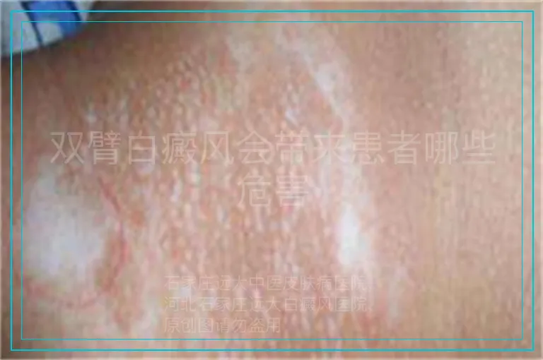 双臂白癜风会带来患者哪些危害