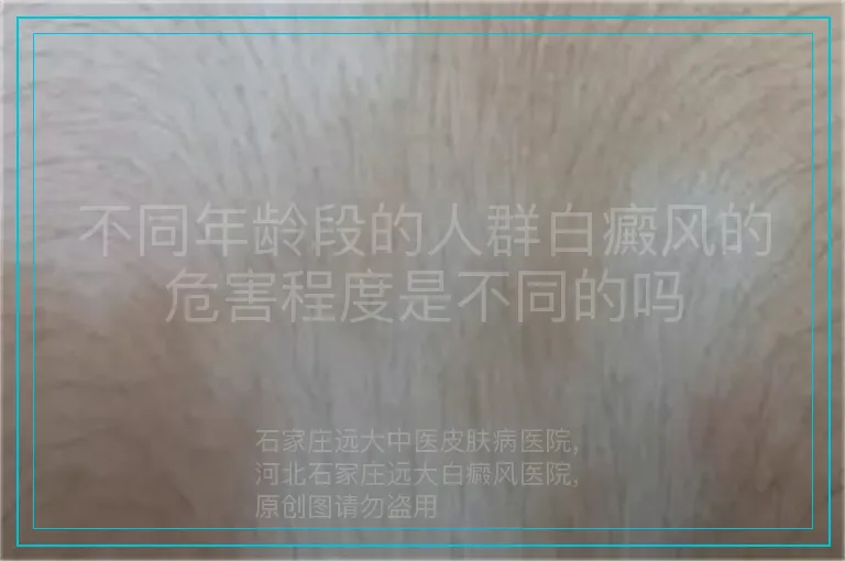 不同年龄段的人群白癜风的危害程度是不同的吗