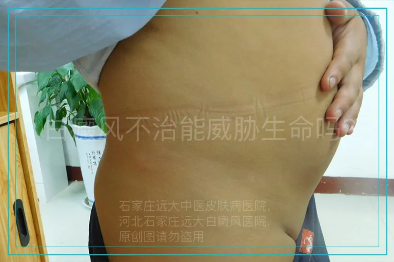 白癜风不治能威胁生命吗?