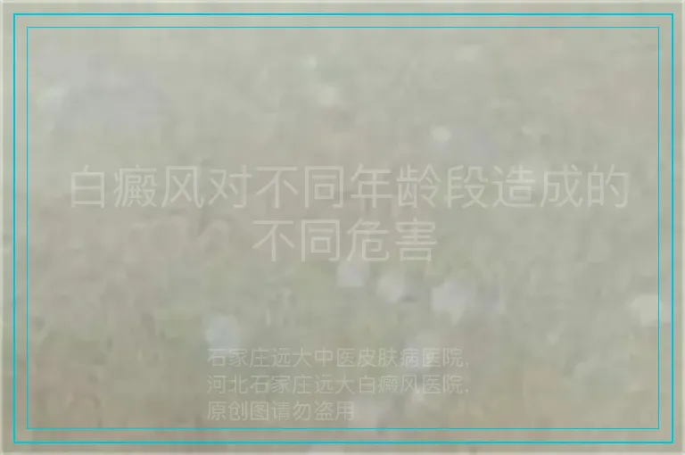 白癜风对不同年龄段造成的不同危害
