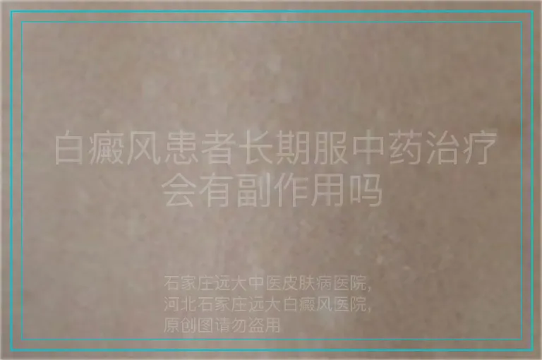 白癜风患者长期服中药治疗会有副作用吗
