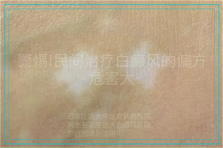 警惕!民间治疗白癜风的偏方危害大