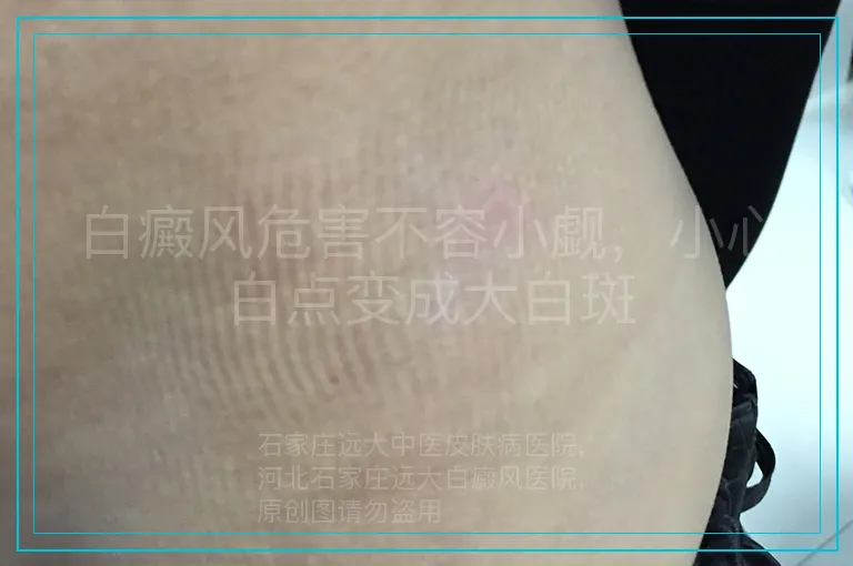 白癜风危害不容小觑，小心白点变成大白斑