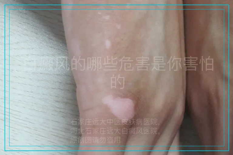 白癜风的哪些危害是你害怕的