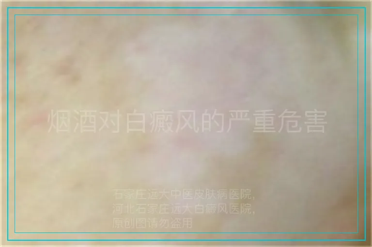 烟酒对白癜风的严重危害