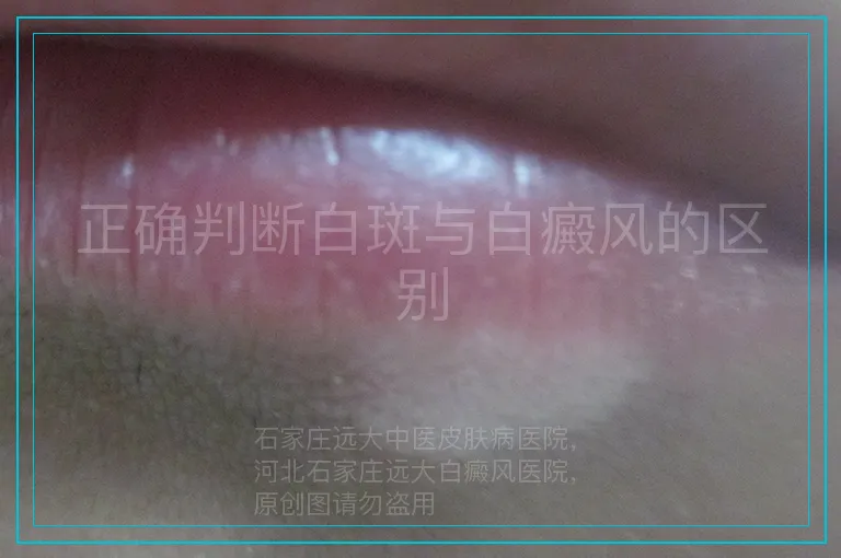 正确判断白斑与白癜风的区别