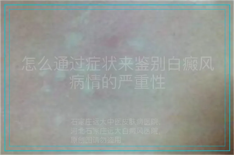 怎么通过症状来鉴别白癜风病情的严重性