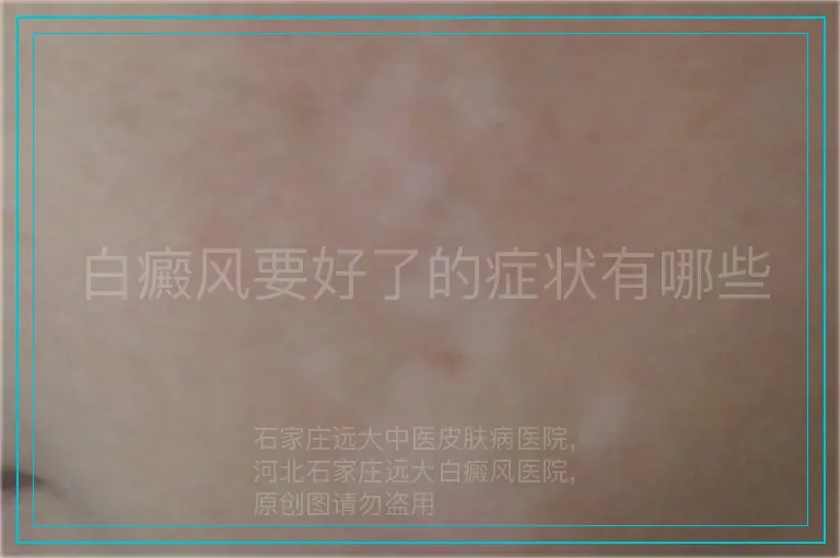 白癜风要好了的症状有哪些