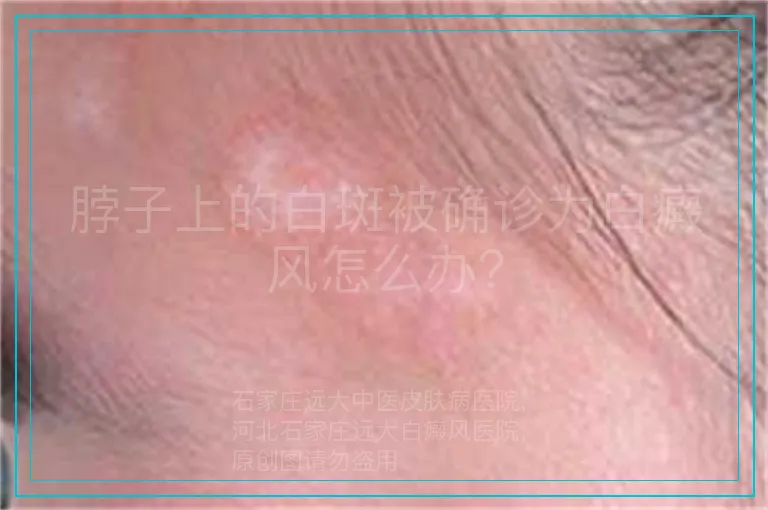 脖子上的白斑被确诊为白癜风怎么办？