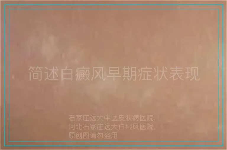 简述白癜风早期症状表现