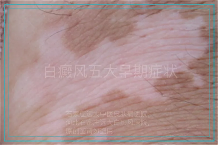 白癜风五大早期症状