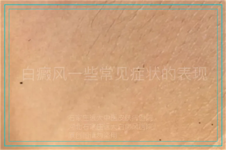 白癜风一些常见症状的表现