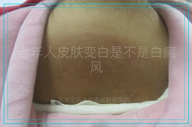老年人皮肤变白是不是白癜风