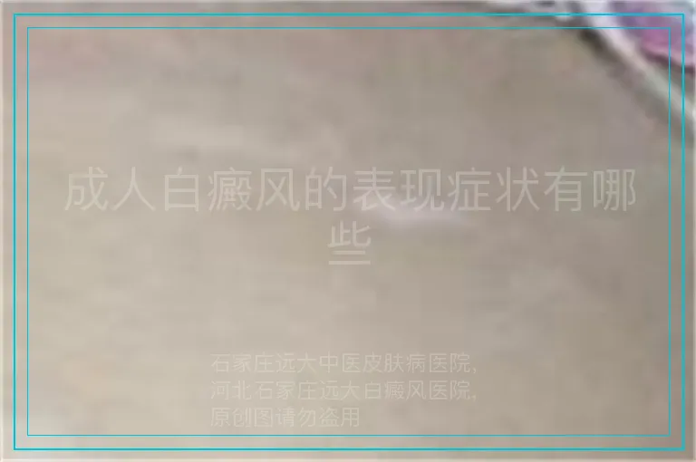 成人白癜风的表现症状有哪些