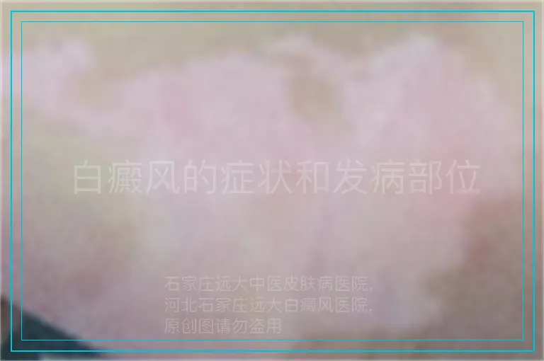 白癜风的症状和发病部位