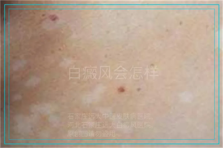 白癜风会怎样