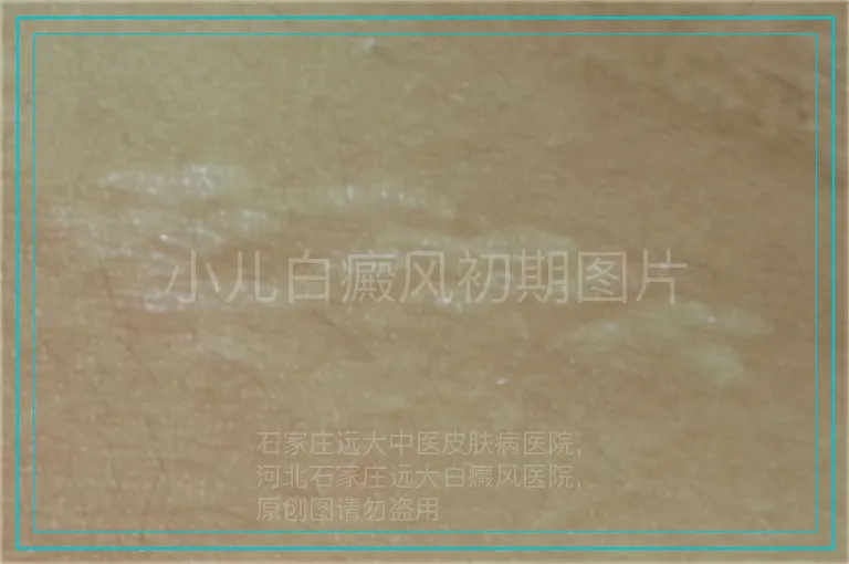小儿白癜风初期图片