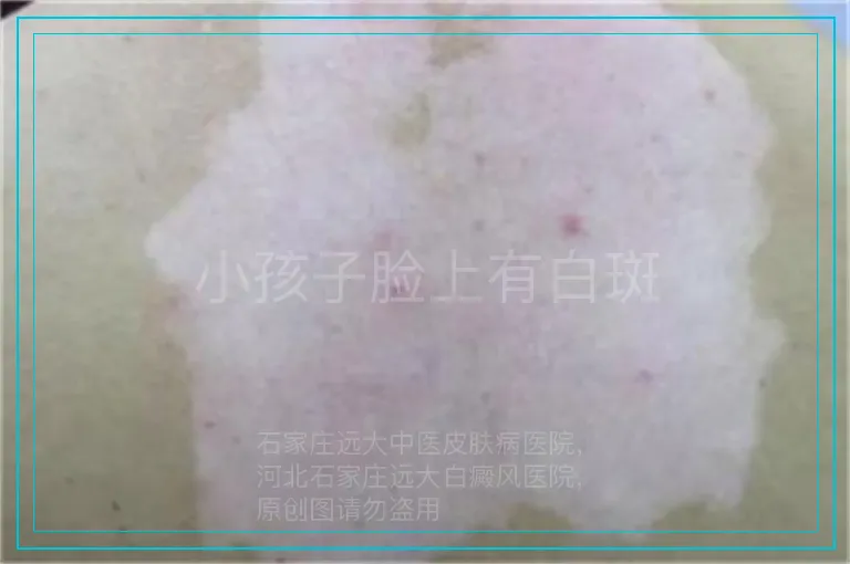 小孩子脸上有白斑