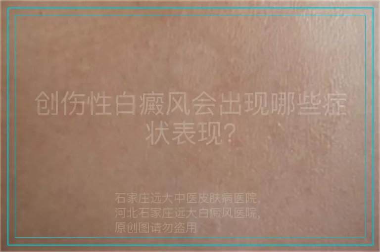 创伤性白癜风会出现哪些症状表现？