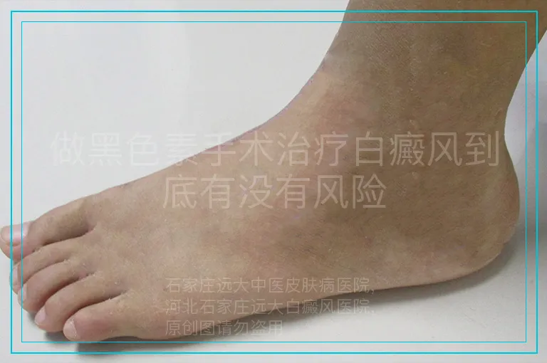 做黑色素手术治疗白癜风到底有没有风险