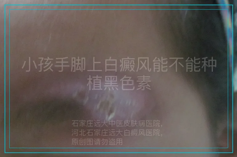 小孩手脚上白癜风能不能种植黑色素