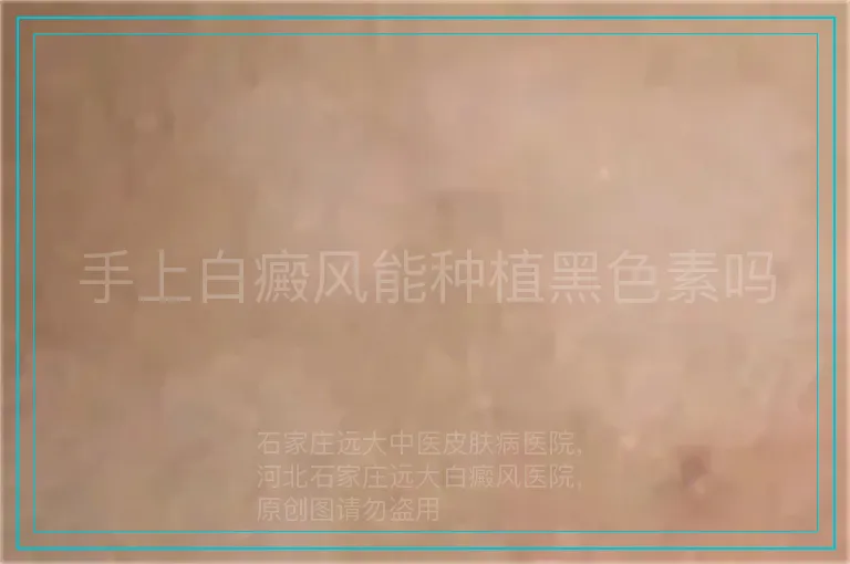 手上白癜风能种植黑色素吗