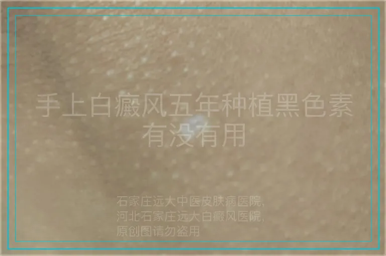 手上白癜风五年种植黑色素有没有用