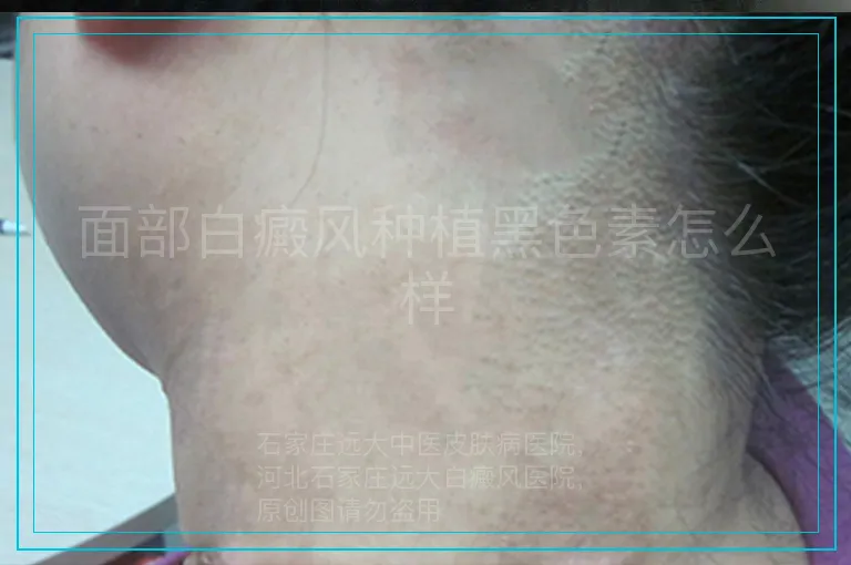 面部白癜风种植黑色素怎么样