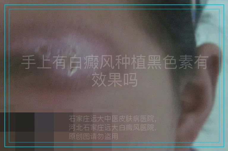 手上有白癜风种植黑色素有效果吗