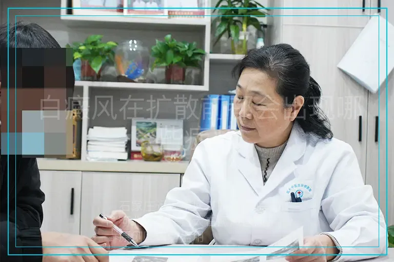 白癜风在扩散前都会出现哪些症状