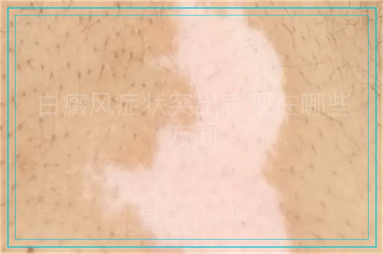 白癜风症状突出表现在哪些方面