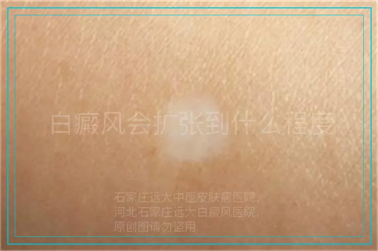 白癜风会扩张到什么程度