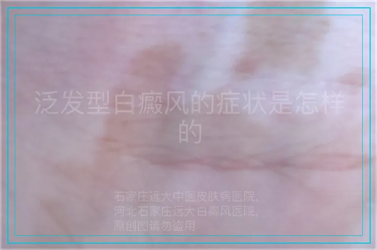 泛发型白癜风的症状是怎样的