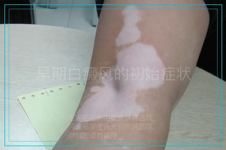 早期白癜风的初始症状