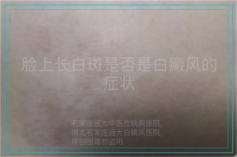 脸上长白斑是否是白癜风的症状